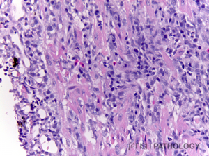 Atlantic salmon, heart with inflammatory infiltrate in compact ventricular myocardium. H&E. 