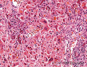 Liver; O. niloticus L.; dissociation of hepatocytes containing brown-staining lipoprotein, degeneration and single cell necrosis, plus early hepatocellular syncytial cell formation and moderate diffuse inflammation H&E.